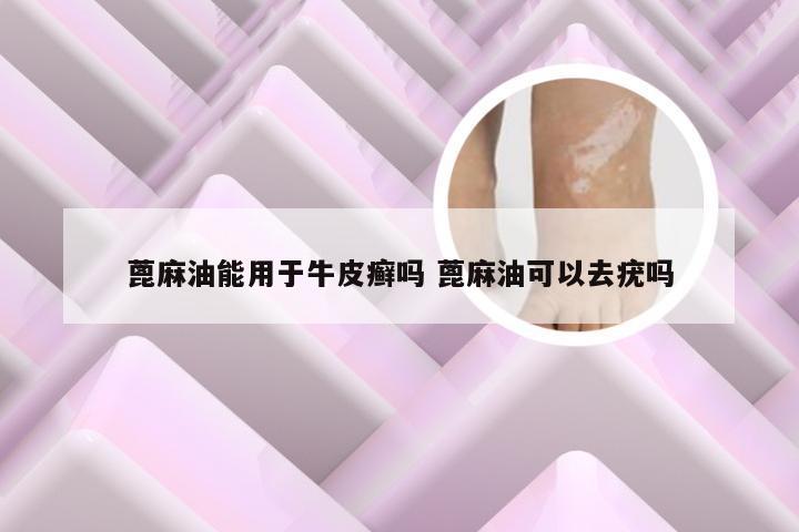 蓖麻油能用于牛皮癣吗 蓖麻油可以去疣吗