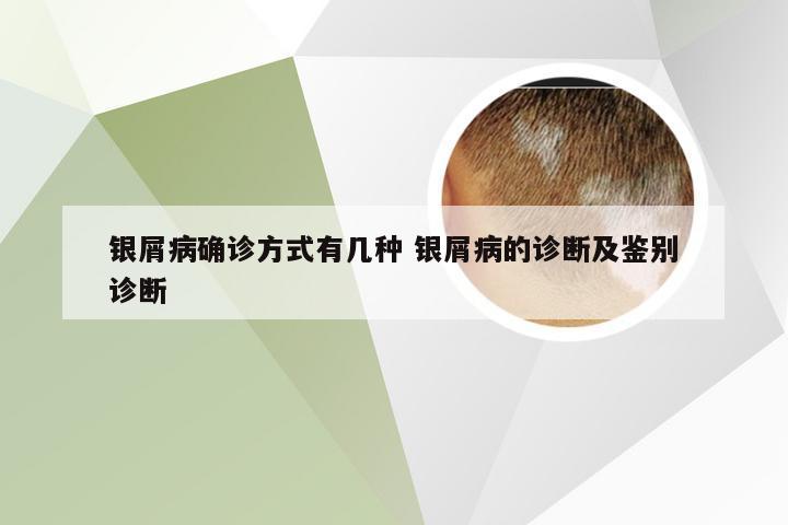 银屑病确诊方式有几种 银屑病的诊断及鉴别诊断
