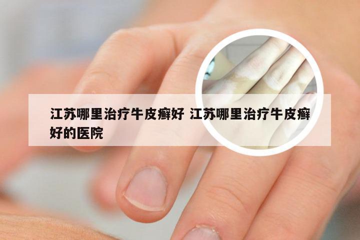 江苏哪里治疗牛皮癣好 江苏哪里治疗牛皮癣好的医院