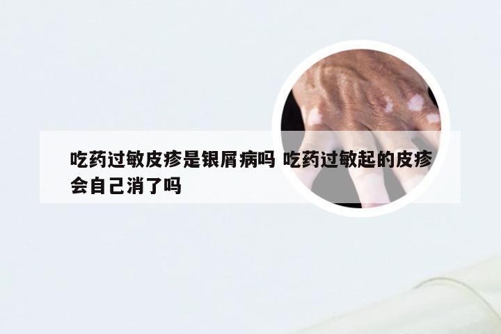 吃药过敏皮疹是银屑病吗 吃药过敏起的皮疹会自己消了吗