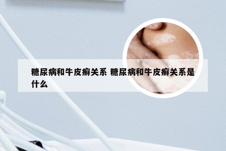 糖尿病和牛皮癣关系 糖尿病和牛皮癣关系是什么
