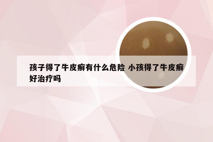 孩子得了牛皮癣有什么危险 小孩得了牛皮癣好治疗吗