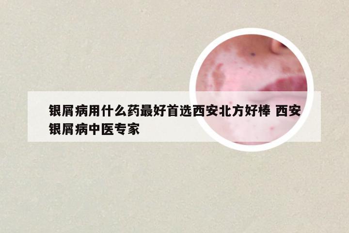 银屑病用什么药最好首选西安北方好棒 西安银屑病中医专家