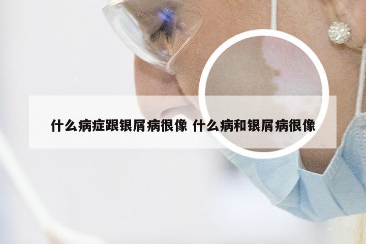 什么病症跟银屑病很像 什么病和银屑病很像