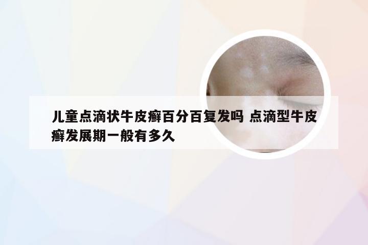 儿童点滴状牛皮癣百分百复发吗 点滴型牛皮癣发展期一般有多久