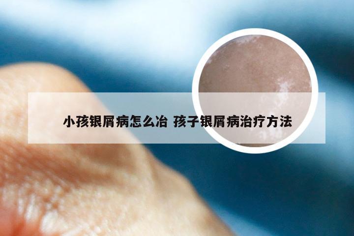 小孩银屑病怎么冶 孩子银屑病治疗方法
