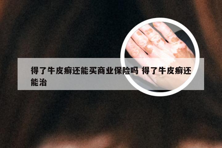 得了牛皮癣还能买商业保险吗 得了牛皮癣还能治