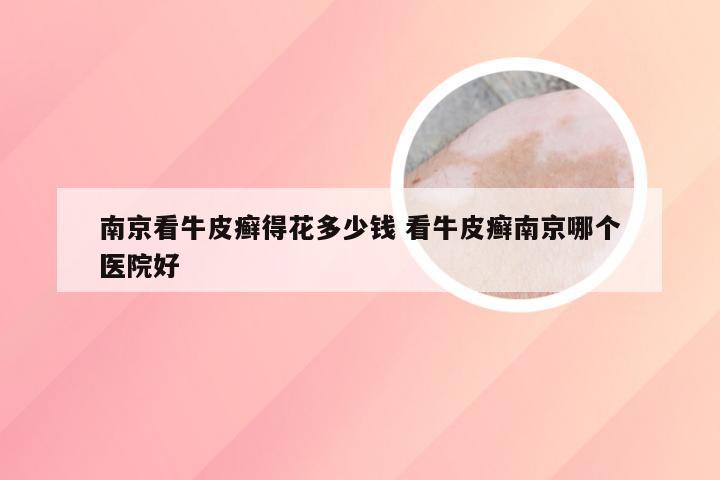 南京看牛皮癣得花多少钱 看牛皮癣南京哪个医院好
