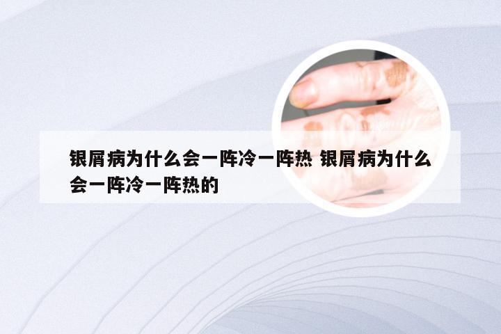 银屑病为什么会一阵冷一阵热 银屑病为什么会一阵冷一阵热的