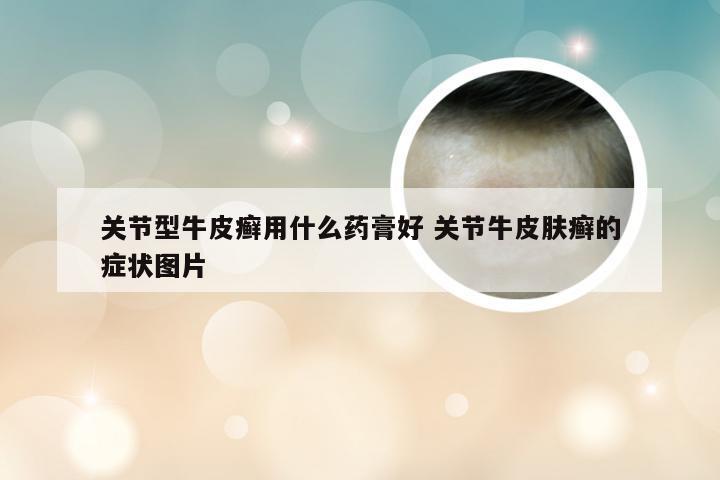 关节型牛皮癣用什么药膏好 关节牛皮肤癣的症状图片