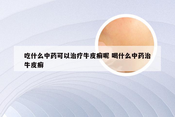 吃什么中药可以治疗牛皮癣呢 喝什么中药治牛皮癣