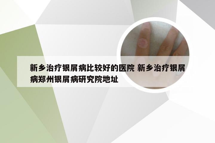 新乡治疗银屑病比较好的医院 新乡治疗银屑病郑州银屑病研究院地址