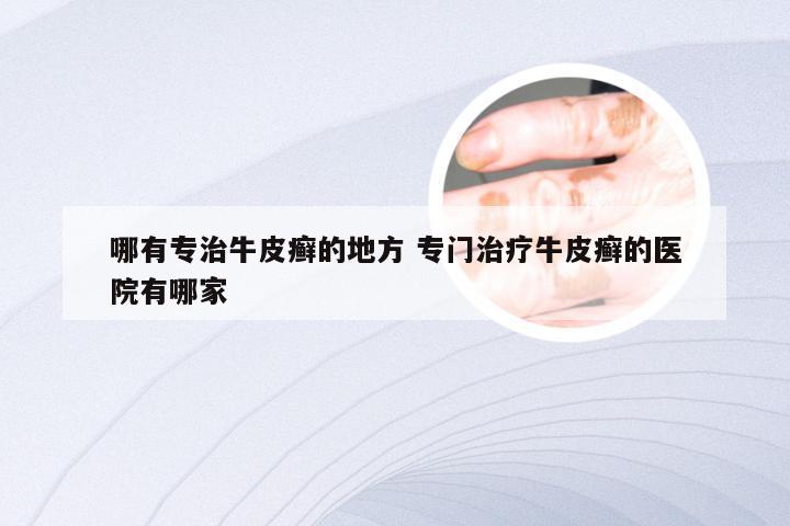 哪有专治牛皮癣的地方 专门治疗牛皮癣的医院有哪家