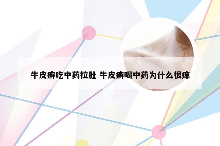 牛皮癣吃中药拉肚 牛皮癣喝中药为什么很痒