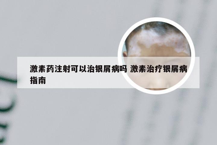 激素药注射可以治银屑病吗 激素治疗银屑病指南
