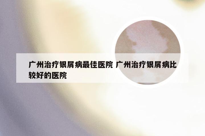 广州治疗银屑病最佳医院 广州治疗银屑病比较好的医院