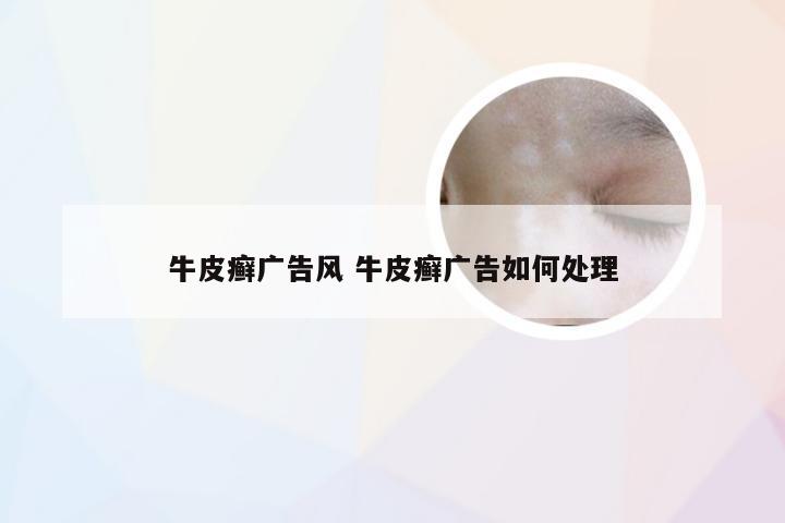 牛皮癣广告风 牛皮癣广告如何处理