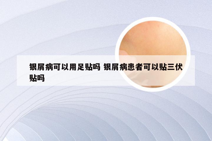 银屑病可以用足贴吗 银屑病患者可以贴三伏贴吗