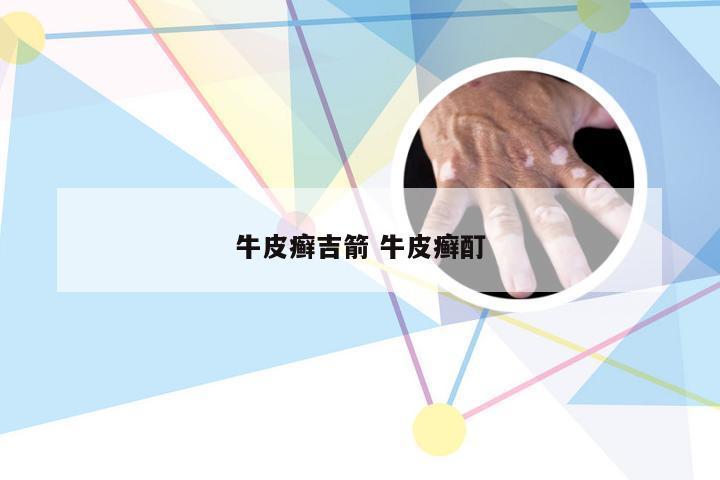 牛皮癣吉箭 牛皮癣酊