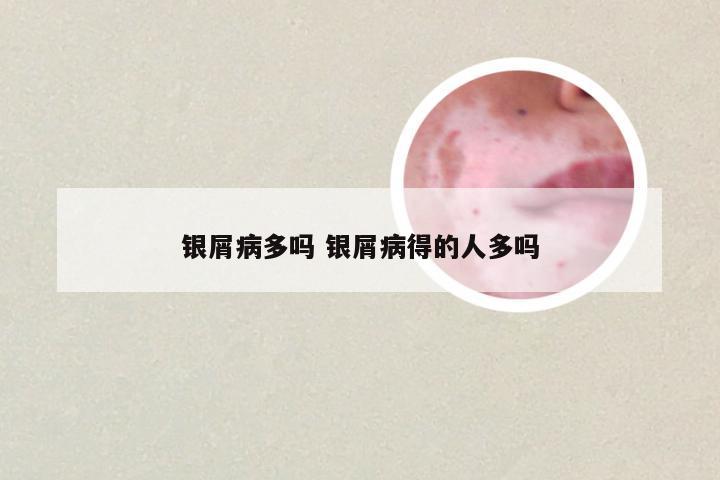 银屑病多吗 银屑病得的人多吗