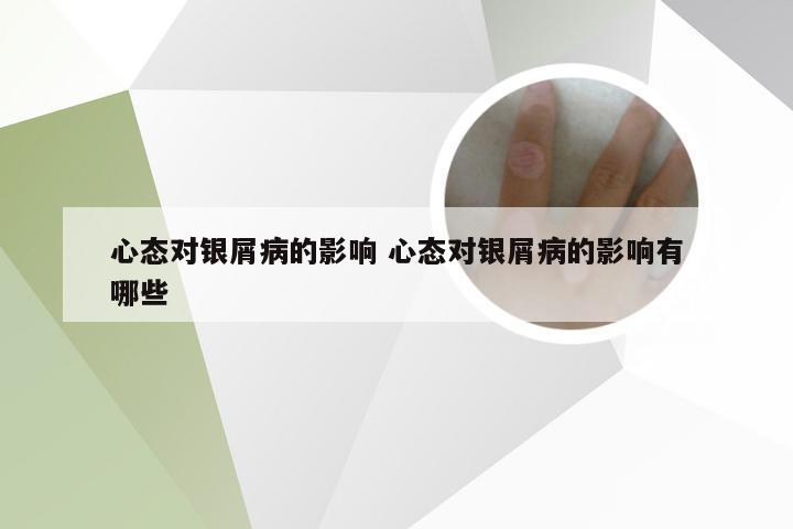 心态对银屑病的影响 心态对银屑病的影响有哪些