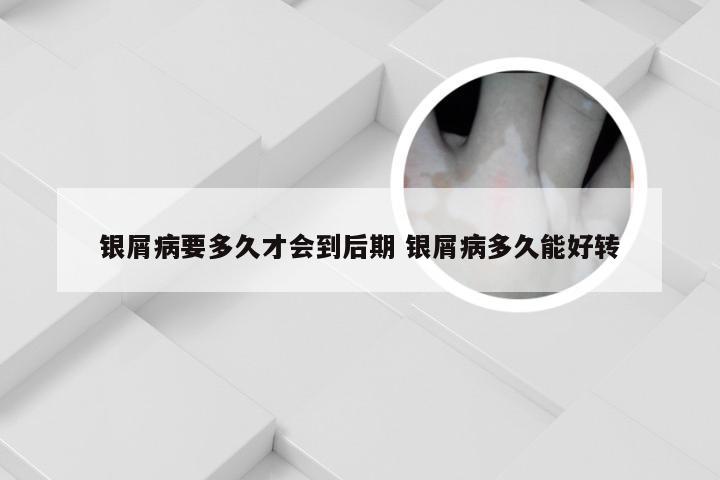 银屑病要多久才会到后期 银屑病多久能好转