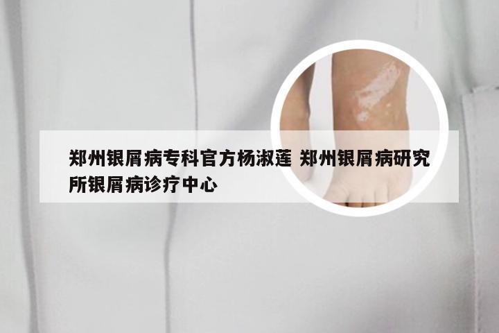 郑州银屑病专科官方杨淑莲 郑州银屑病研究所银屑病诊疗中心