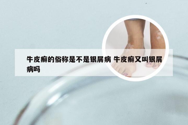 牛皮癣的俗称是不是银屑病 牛皮癣又叫银屑病吗