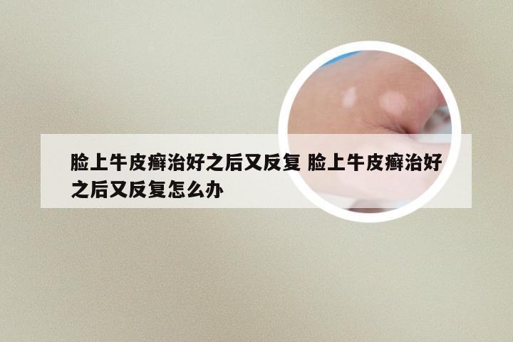 脸上牛皮癣治好之后又反复 脸上牛皮癣治好之后又反复怎么办