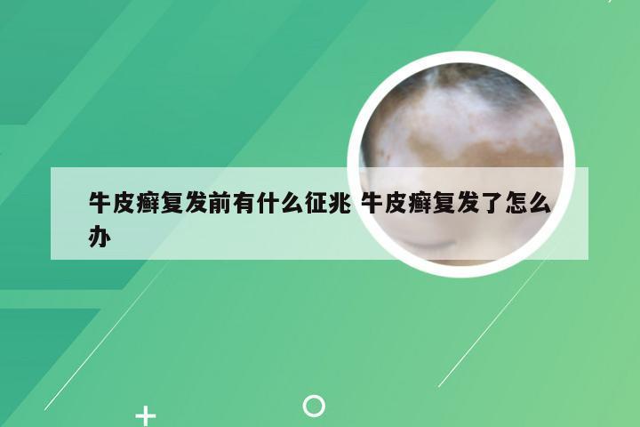 牛皮癣复发前有什么征兆 牛皮癣复发了怎么办