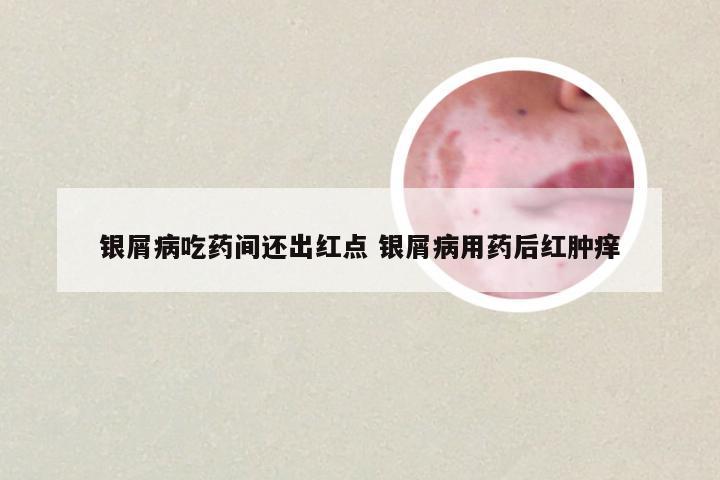 银屑病吃药间还出红点 银屑病用药后红肿痒