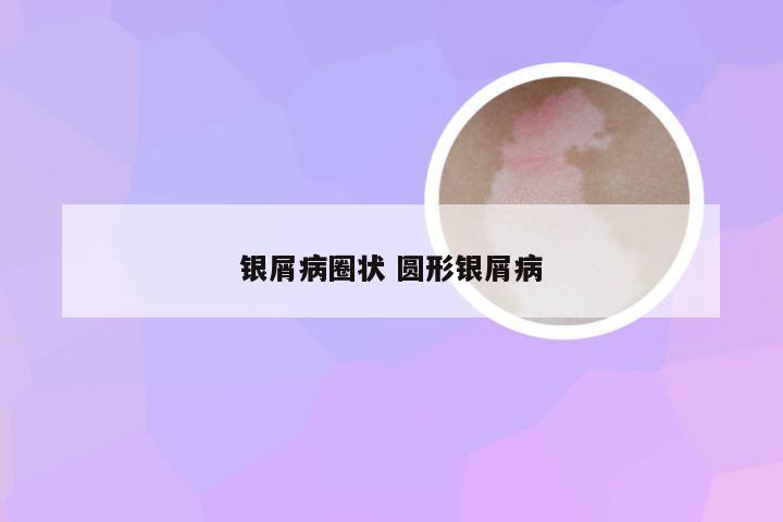银屑病圈状 圆形银屑病