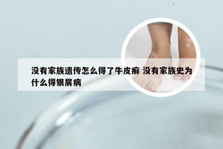 没有家族遗传怎么得了牛皮癣 没有家族史为什么得银屑病