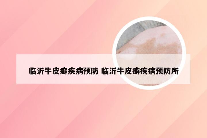 临沂牛皮癣疾病预防 临沂牛皮癣疾病预防所