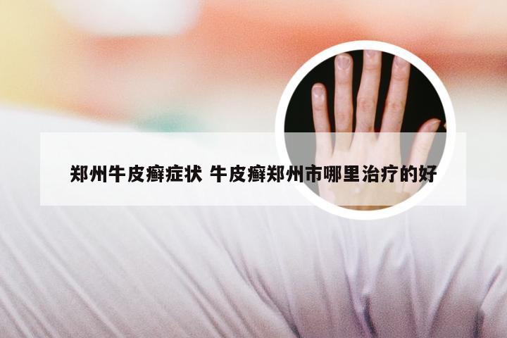 郑州牛皮癣症状 牛皮癣郑州市哪里治疗的好