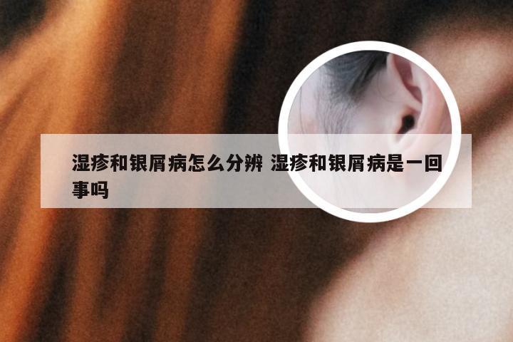 湿疹和银屑病怎么分辨 湿疹和银屑病是一回事吗