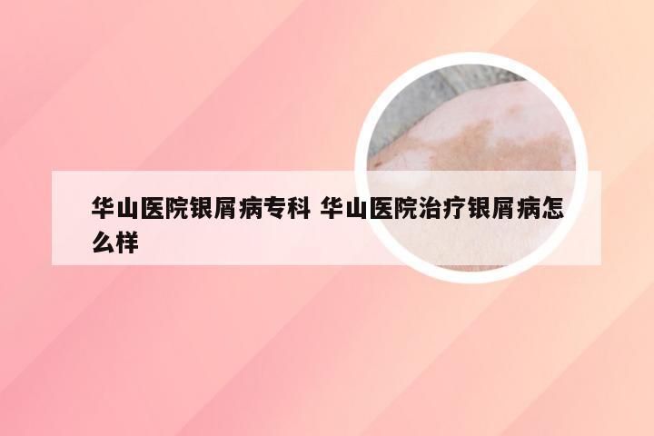华山医院银屑病专科 华山医院治疗银屑病怎么样