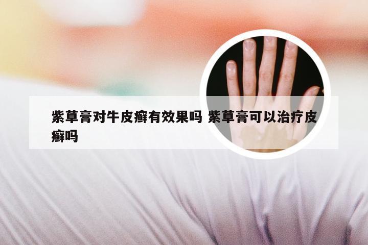 紫草膏对牛皮癣有效果吗 紫草膏可以治疗皮癣吗
