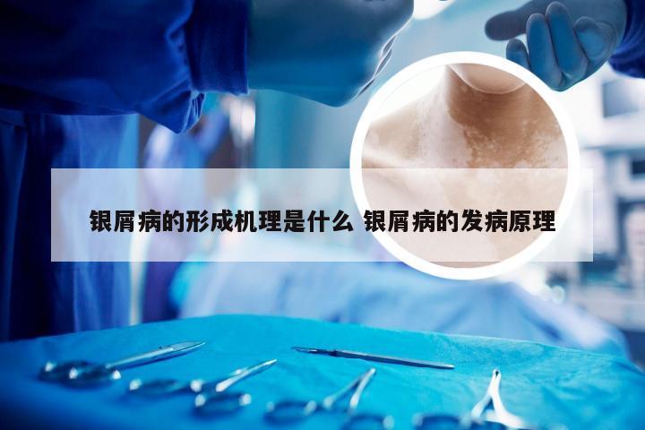 银屑病的形成机理是什么 银屑病的发病原理