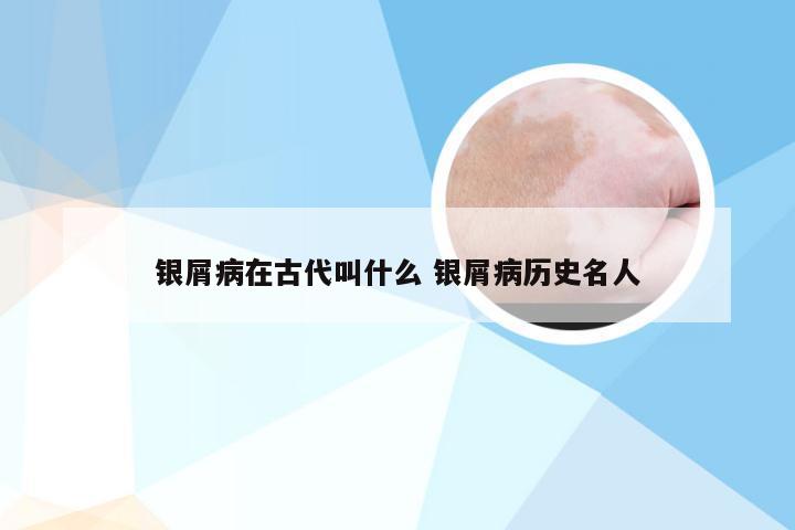 银屑病在古代叫什么 银屑病历史名人