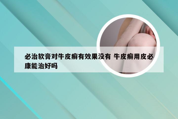 必治软膏对牛皮癣有效果没有 牛皮癣用皮必康能治好吗