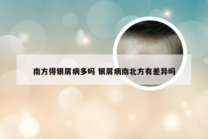 南方得银屑病多吗 银屑病南北方有差异吗