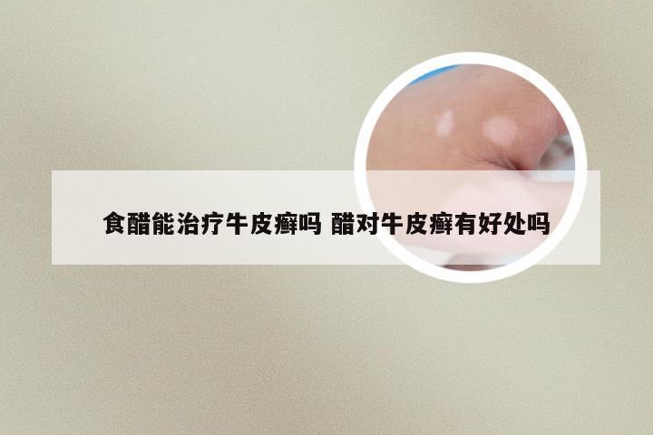 食醋能治疗牛皮癣吗 醋对牛皮癣有好处吗
