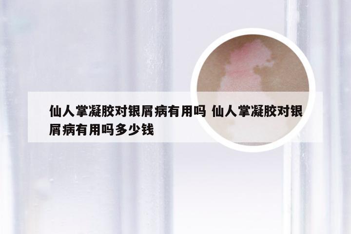 仙人掌凝胶对银屑病有用吗 仙人掌凝胶对银屑病有用吗多少钱
