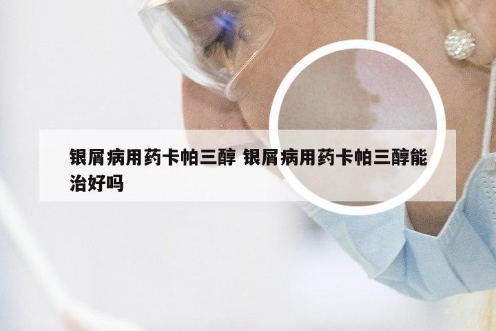 银屑病用药卡帕三醇 银屑病用药卡帕三醇能治好吗