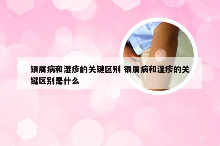 银屑病和湿疹的关键区别 银屑病和湿疹的关键区别是什么