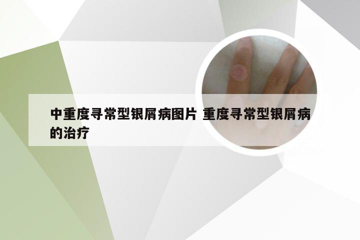 中重度寻常型银屑病图片 重度寻常型银屑病的治疗
