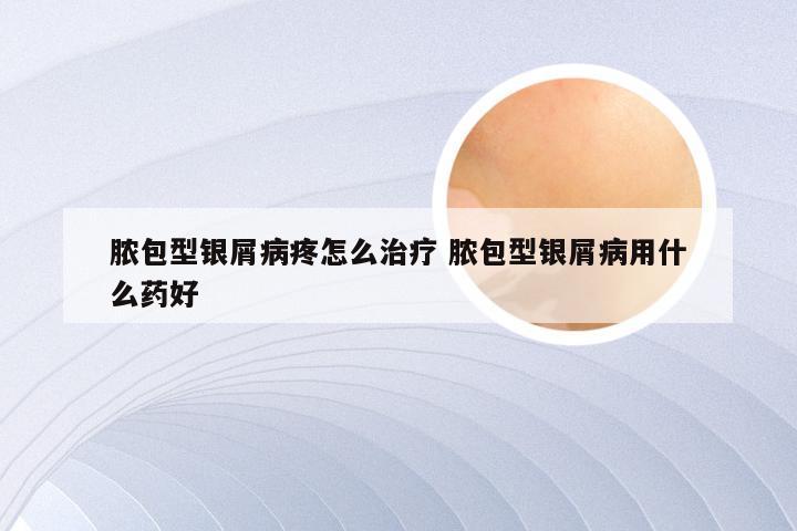 脓包型银屑病疼怎么治疗 脓包型银屑病用什么药好