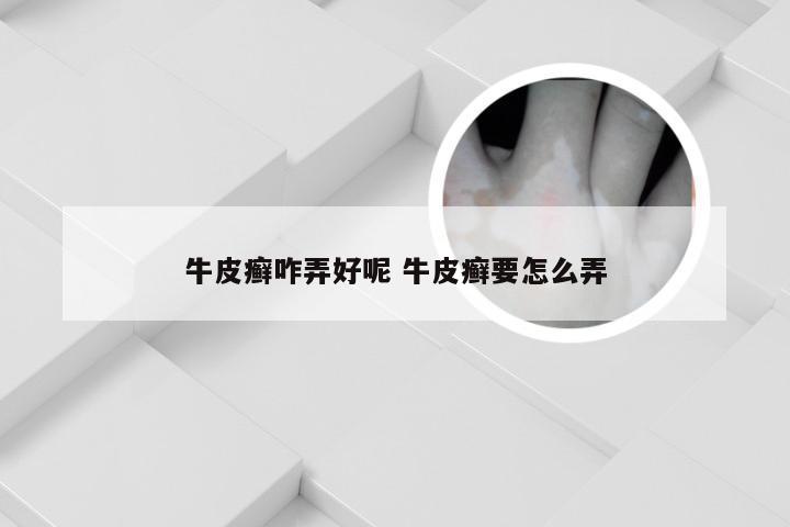 牛皮癣咋弄好呢 牛皮癣要怎么弄