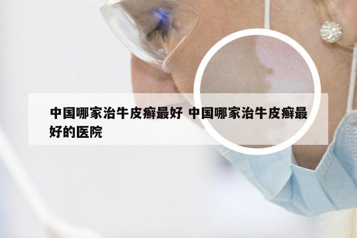 中国哪家治牛皮癣最好 中国哪家治牛皮癣最好的医院